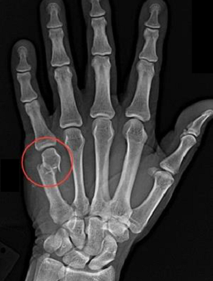 چگونه می‌توان شکستگی انگشت دست را تشخیص‌داد؟